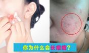 臉上長痘痘是什么原因？請問主要是什么原因呢？