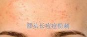 額頭長痘，臉頰長痘痘粉刺，就這樣恢復嫩白肌膚！