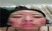 【祛痘視頻反饋】激素臉長痘20多年，大膿包，發癢，完全恢復！