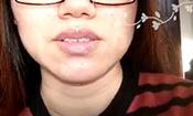 【祛痘視頻反饋】經期容易長痘，讓人很絕望，現在已經沒有痘痘了。